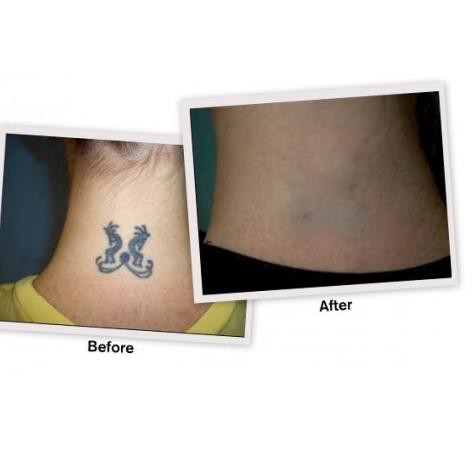 TATTONOX / TATONOX OBAT PENGHAPUS PENGHILANG TATTO TATO ORIGINAL 100% ♕