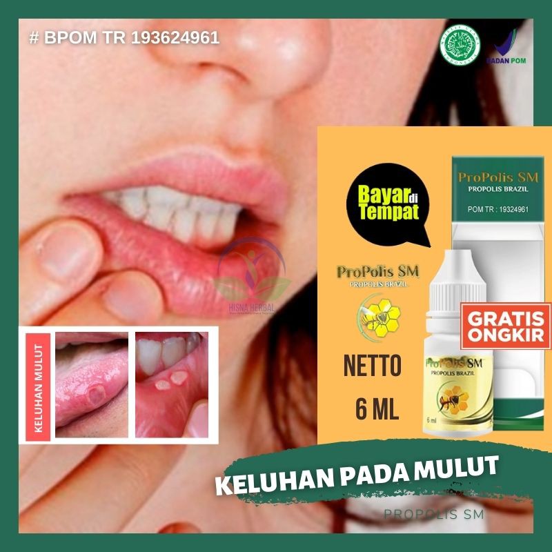 Obat Herbal Tumor Mandibula, Benjolan Sariawan, Abses Di Mulut,Tumor Rahang, Kista Rahang Alami Asli
