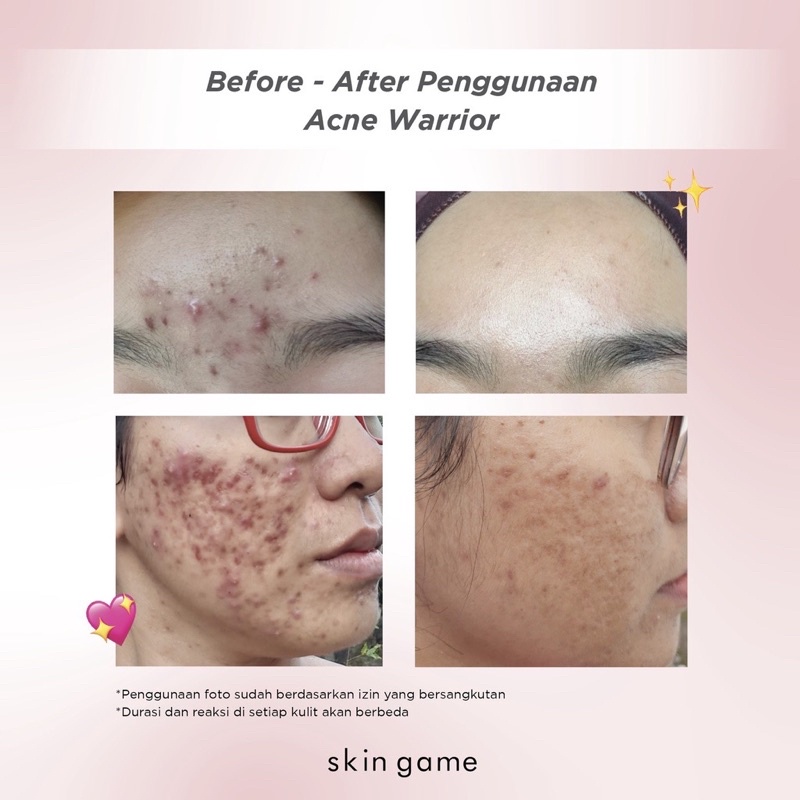 SKIN GAME Acne Warrior 30gr | 10gr