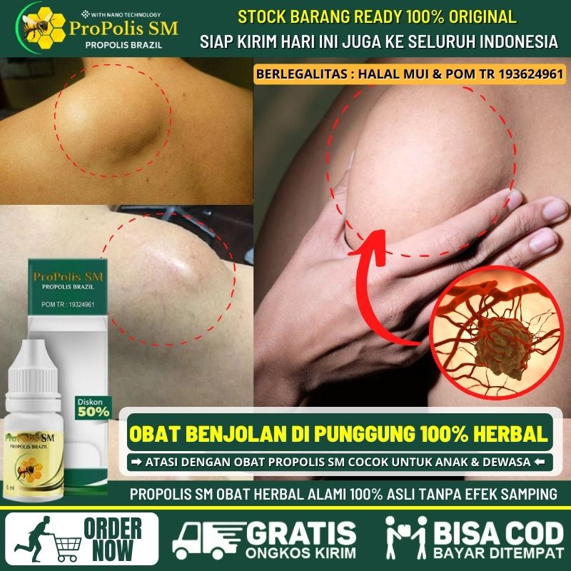 Salep Alami Benjolan di Punggung, Obat Oles Penghilang Benjolan Abnormal di Punggung Belakang, Obat 