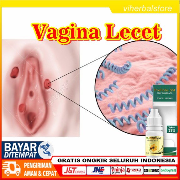 Obat Vagina Lecet Obat Tetes Vagina Lecet Obat Oles Vagina Lecet Obat Vagina Perih Propolis Sm Shopee Indonesia