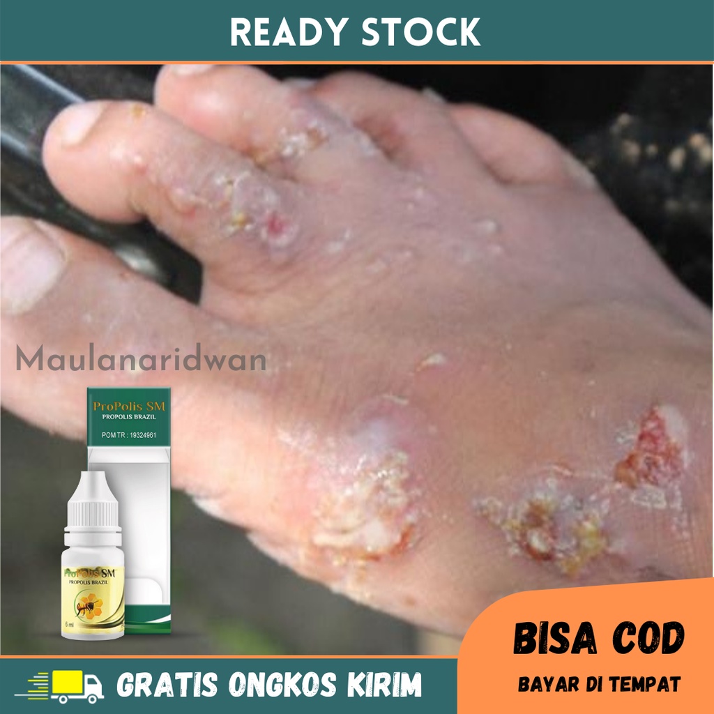 Obat Gatal Budug, Obat Kulit Gatal Budug, Obat Budug Bernanah, Obat Penghilang Luka Budug, Obat Budu