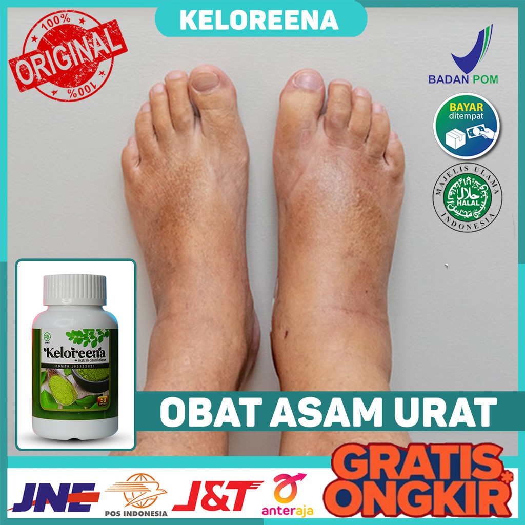 Obat Asam Urat, Asam Urat Kaki, Asam Urat Tangan, Rematik, Encok, Kolesterol - Keloreena di Surabaya