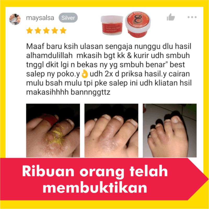 Salep Obat Gatal Eksim Kering Basah Menahun Paling Ampuh Kurap Panu Selangkangan Jamur Gatel Kulit-3