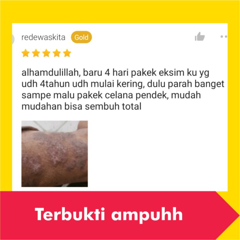 Salep Obat Gatal Eksim Kering Basah Menahun Paling Ampuh Kulit Gatel Kurap Kudis Selangkangan Jamur-1