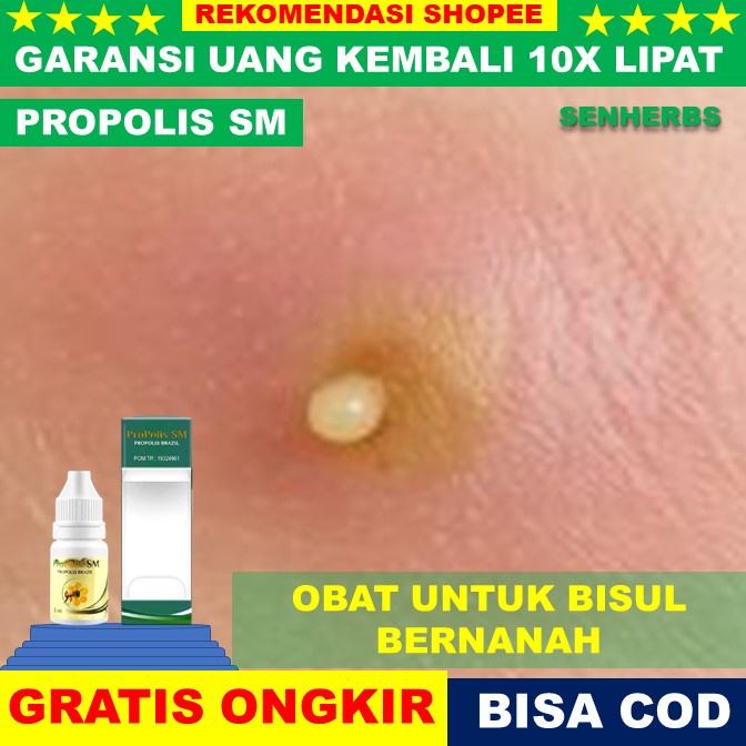 obat bisul bernanah  Obat Bisul - Obat Bisulan, Salep Bisul, Obat Tetes Bisul, Obat Benjolan Bernana