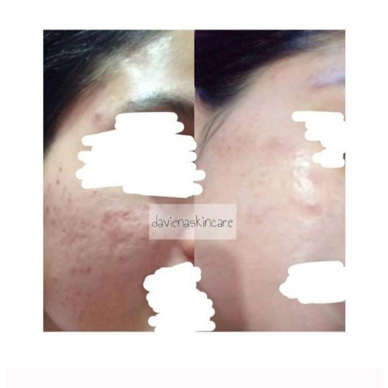 HA SERUM DAVIENA|SERUM BOPENG|DAVINA|DAVIENA SKINCARE|DAVIENA|SERUM HA DAVIENA