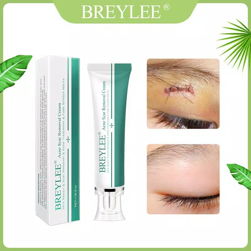 BREYLEE Acne Cream Krim Penghilang Noda Bekas Jerawat, Luka &amp; Stretch Mark (30g)