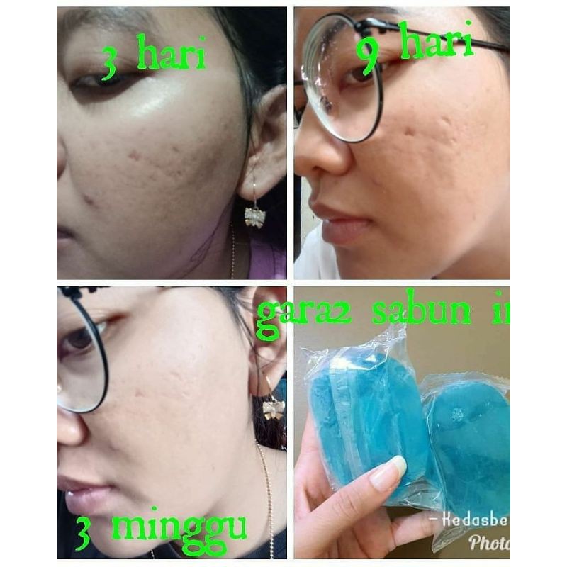 Brightening Soap Kedas Beauty | BPOM Best Seller-2