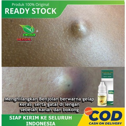 PROPOLIS SM Berkhasiat Untuk Menghilangkan Benjolan berwarna gelap, keras, serta gatal di lengan seb