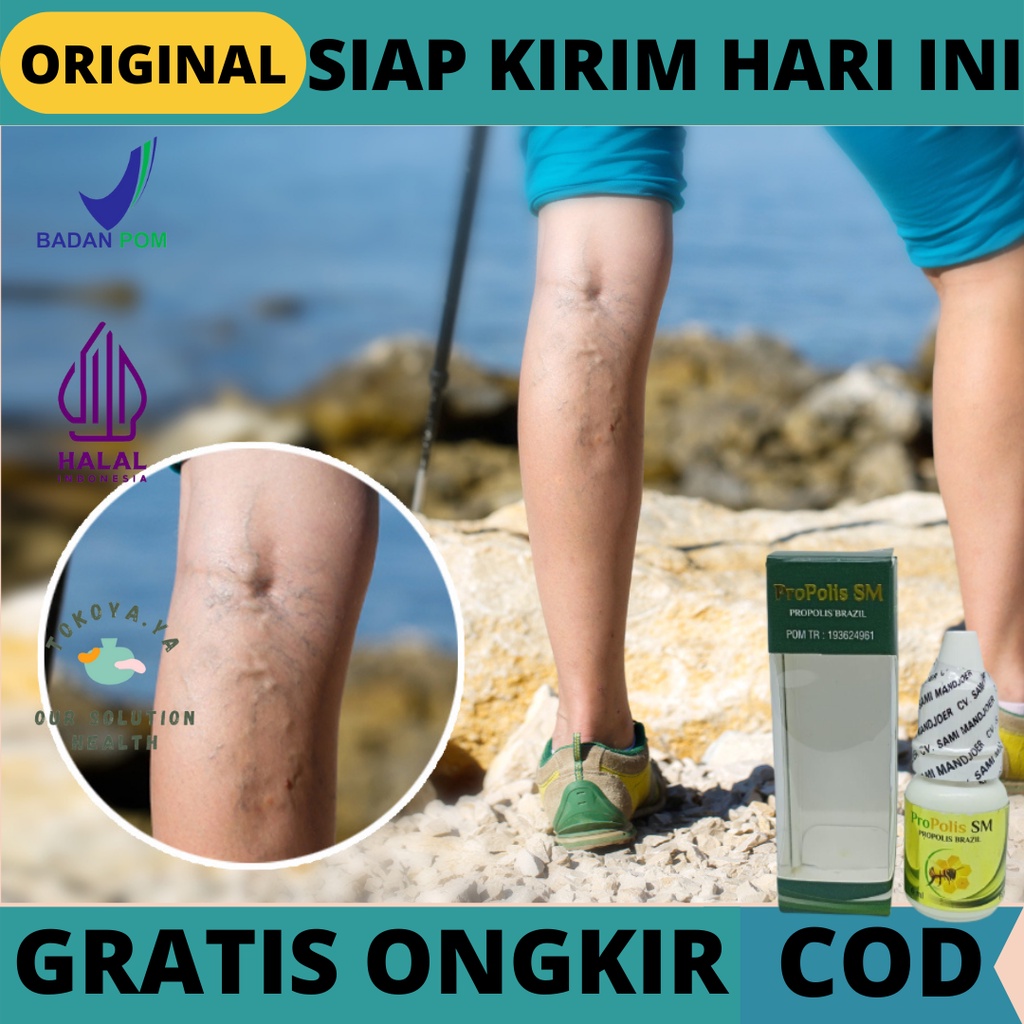 PROPOLIS SM 100% ORIGINAL BPOM, Obat Varises Betis, Obat Herbal Pengobatan Varises kaki, Obat Penghi