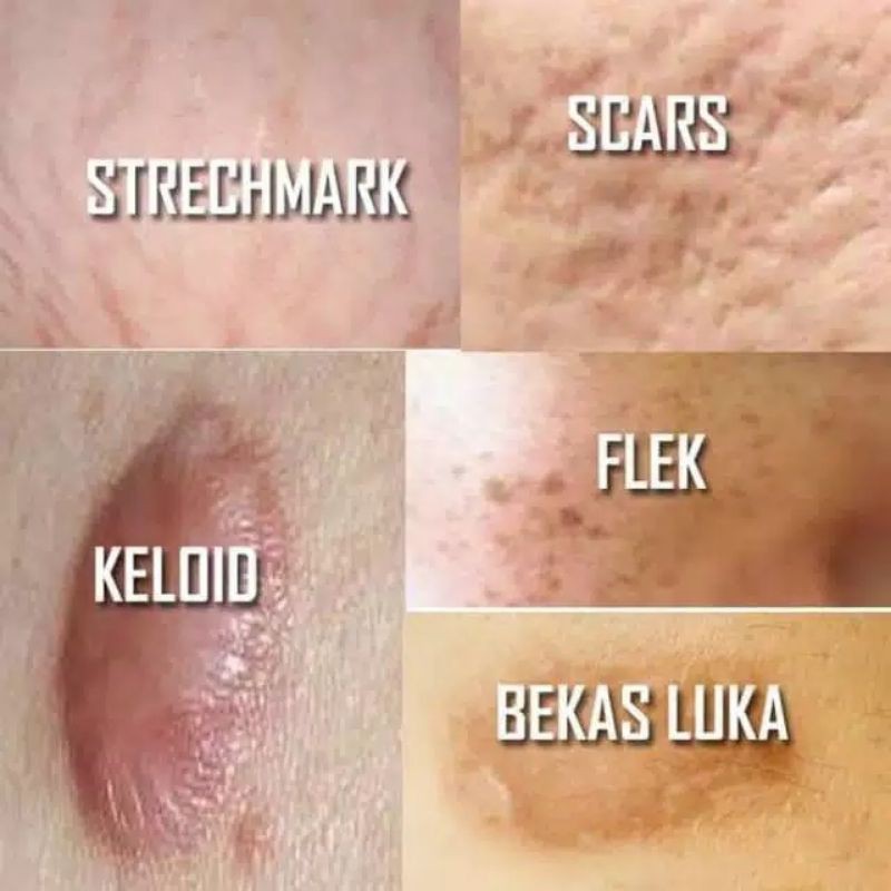 DIAMOND SERUM(bekas luka/KELOID/strechMark/ flek /PORI”