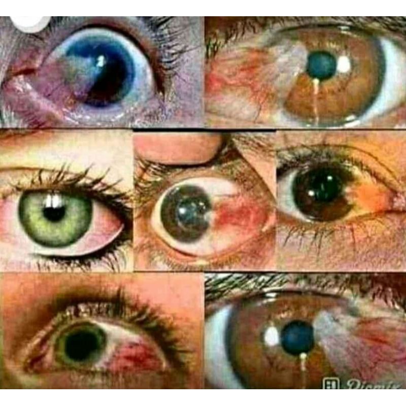 OXPW, OBAT PENJERNIH MATA