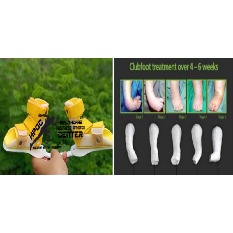 Sepatu Bayi Kaki Pengkor Kedalam / CTEV