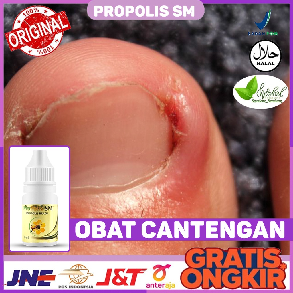 Obat Cantengan - Obat Cantengan Berdarah - Obat Cantengan Bau - Obat Kuku Busuk - Obat Cantengan Kuk