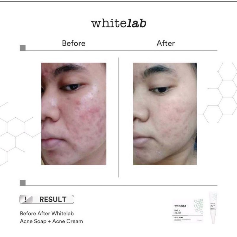 Whitelab Acne Cream