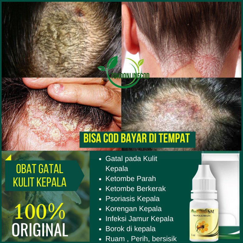 Obat Gatal Kulit Kepala Ketombe Rambut Kerak Kulit Kering Bersisik Koreng Berjamur Propolis Sm Shopee Indonesia