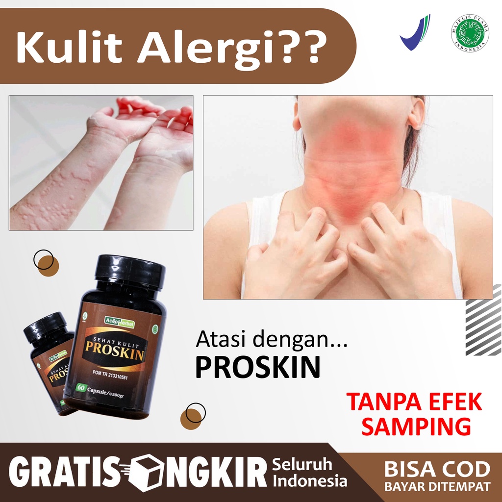 Obat Biduran Alergi Makanan Dingin Biduran Paling Alami untuk Penghilang Alergi Semen Gatal Kulit Be