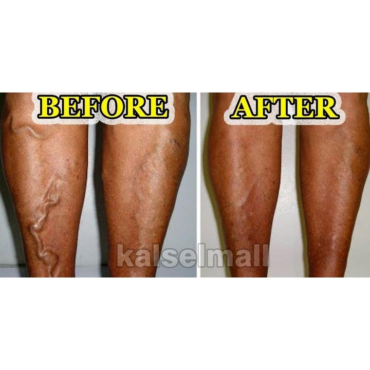 Obat Salep Krim Cream Penghilang Varises Paises Herbal Aman 100% ORIGINAL Maiguankanggao Salap Cina Herbal Tanpa Efek Samping Varicose Veins  Parises Ampuh China Untuk Pengobatan Varises Kaki Tangan Badan Kulit Pegal - Pegal OC4