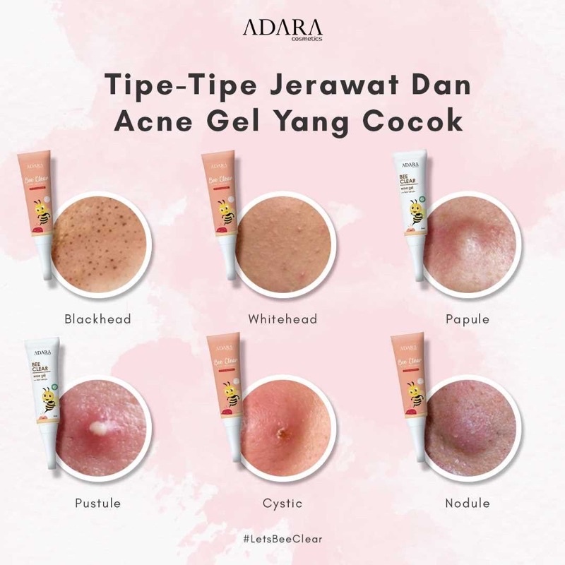 ADARA P.M.S Series Acne Spot Bee Clear Acne | Extra Formula | Serum Acne | Adara Moisturizer | Facewash Acne | Toner Acne | Acne Treatment jerawat