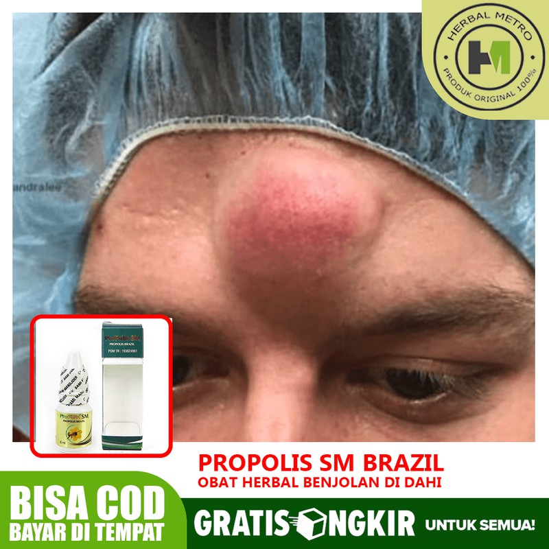 Obat Benjolan Di Dahi Kiri Kanan Benjolan Di Jidat Kiri Kanan Propolis Sm Brazil Shopee Indonesia