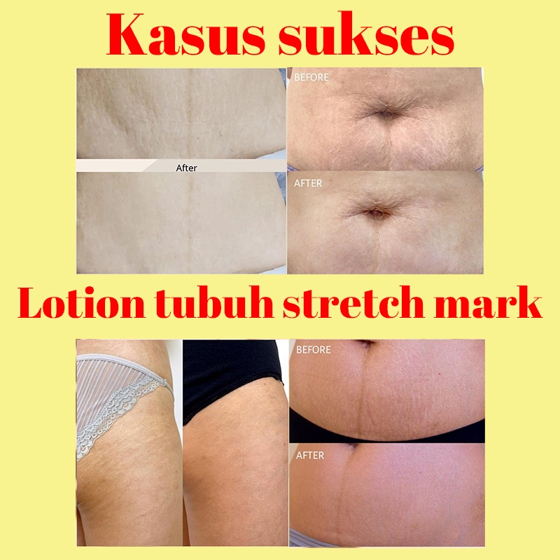 【O'RANNLE】 Stretch Mark Cream Mama's Choice Bisa dipakai ibu hamil   Menghilangkan stretch mark Memudarkan stretch mark Lotion tubuh stretch mark Krim perbaikan pasca persalinan Garis kegemukan Garis pertumbuhan