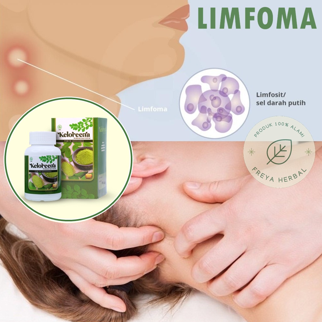 OBAT KANKER LIMFOMA, OBAT KANKER KELENJAR GETAH BENING, OBAT LIMFOMA HODGKIN, OBAT LIMFOMA NON HODGK