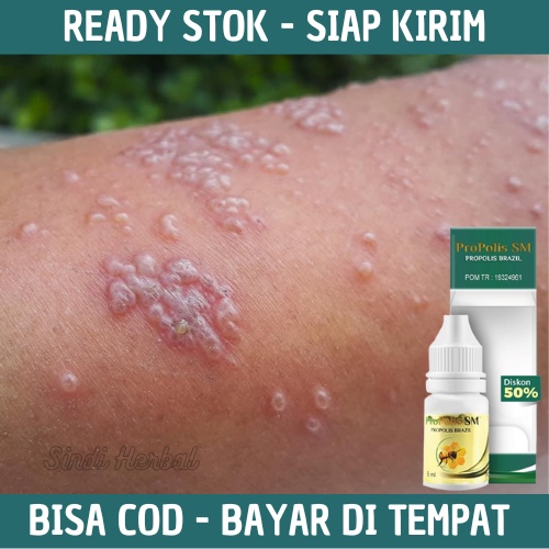 Obat Cacar Air - Obat Cacar Api - Obat Cacar Anak - Obat Cacar Dewasa - Obat Cacar Air Pada Bayi - P