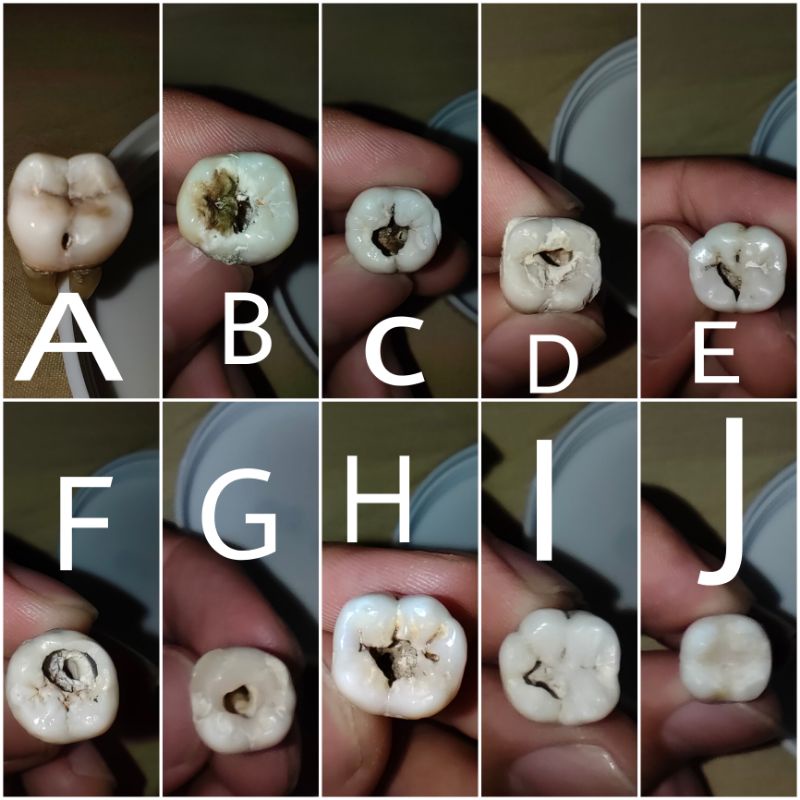 Jual Gigi praktikum Endo / gigi berlubang sampai pulpa di occlusal