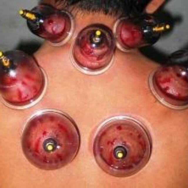 Pengobatn bekam hijamah