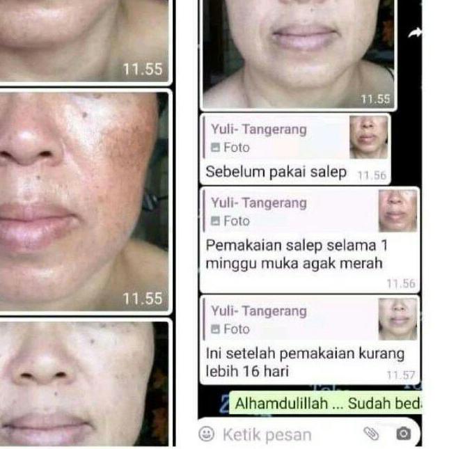 ♢ flek bandel liz skincare / flek hitam / cream flek / salep flek membandel ℮