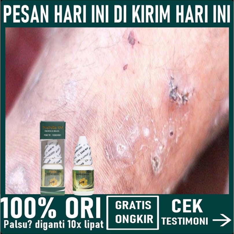OBAT SCABIES / KUDIS, SALEP SCABIES MANUSIA, OBAT GUDIK GATAL, OBAT LUKA BERNANAH, OBAT GATAL EKSIM,