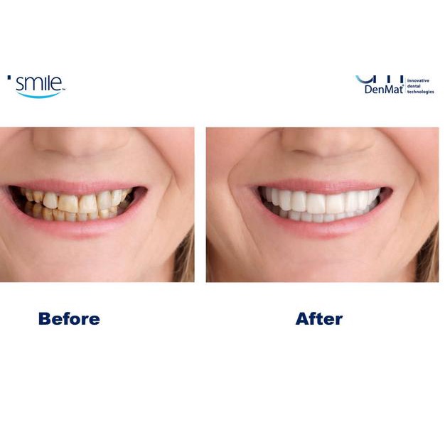 Paling Dicari.. PROMO Snap On Smile 100% ORIGINAL Authentic / Snap 'n Smile Gigi Palsu