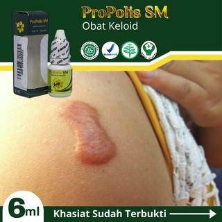 Obat Menghilangkan Keloid Yang Sudah Bertahun Tahun Mengobati Keloid Yang Gatal Propolis Sm Shopee Indonesia