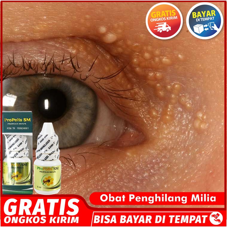 Obat Milia, Obat Penghilang Milia, Obat Milia Di Wajah, Obat Milia Di Bawah Mata Propolis SM Asli