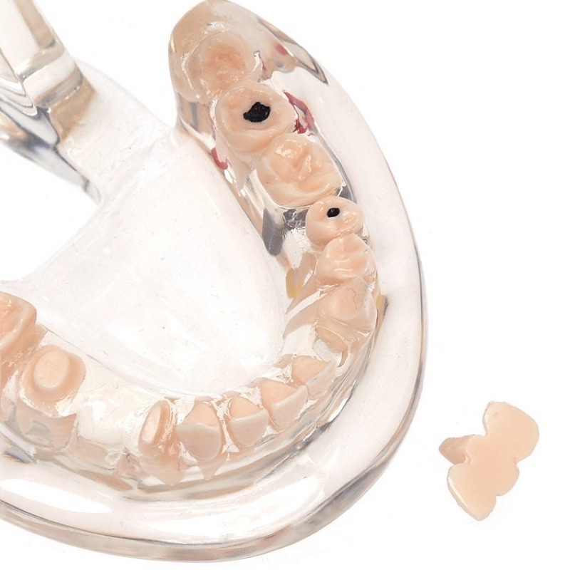 Dental Study Model Gigi Orthodontic Malocclusion PVC + Resin / Patung Gigi Phantom Bisa Di Lepas