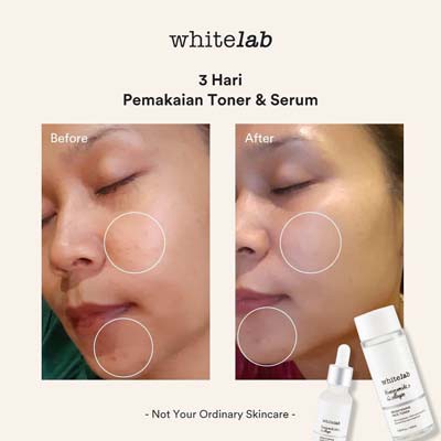 [FREE GIFT] WHITELAB ACNE CALMING SERUM &amp; BRIGHTENING FACE SERUM 20 ML