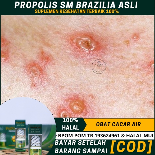 Obat Cacar, Obat Cacar Air, Obat Cacar Api, Obat Cacar Ular, Obat Campak, Obat Gatal Cacar, Salep Ca