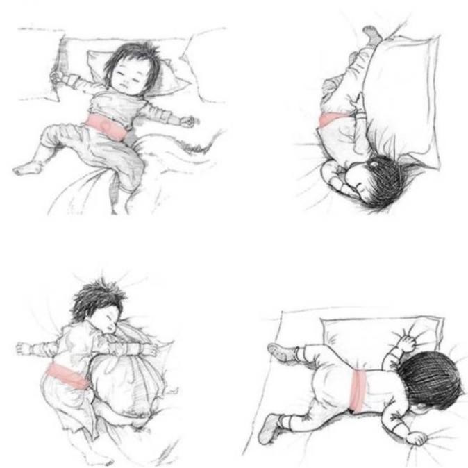 Baby Infantile Umbilical Hernia / Sabuk Hernia Bayi