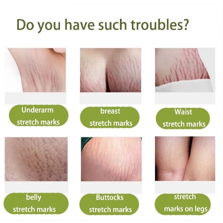 Penghilang strechmark Krim stretch mark Strecth Mark Cream 30ml Krim Perawatan Pascapersalinan Krim Hilangkan Garis-Garis Lemak Menghilangkan Strech Mark Menghilangkan Garis-Garis Lemak Pada Perut, Paha Dan Pantat-1