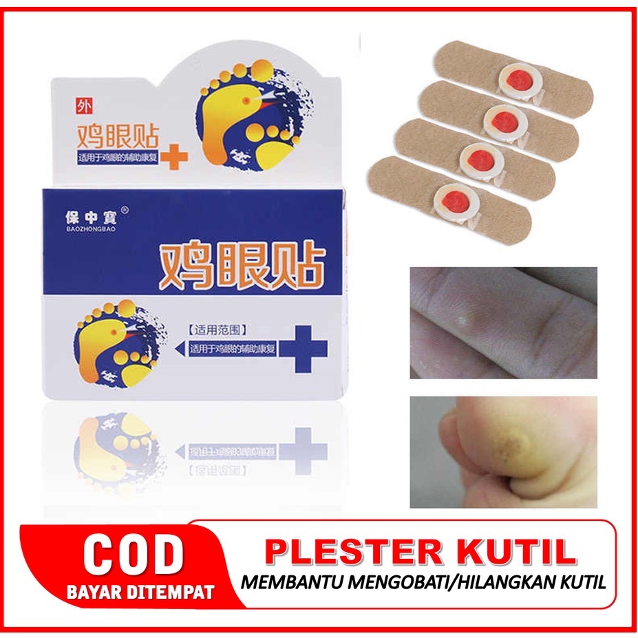 Obat Perontok Kutil di leher - Obat Papiloma - Obat Penghilang Papiloma di leher - Obat Penghilang D