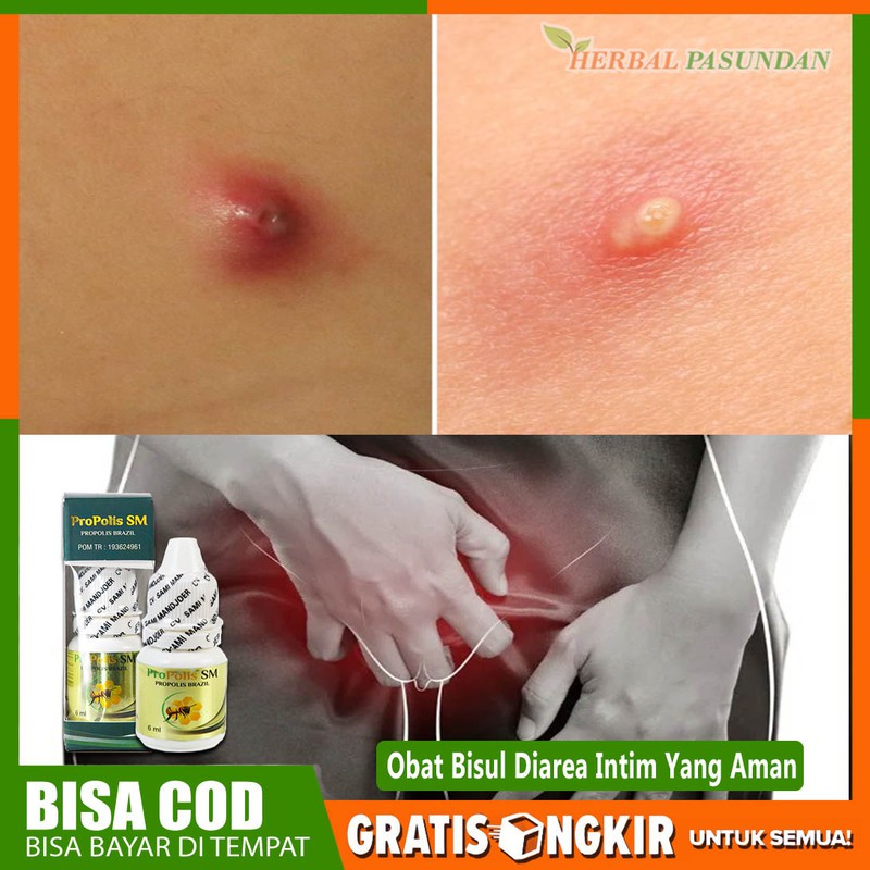 Obat Bisul - Obat Bisulan - Di Area Intim Terlaris- Obat Bisul Alami Di Anus Dengan Propolis Sm