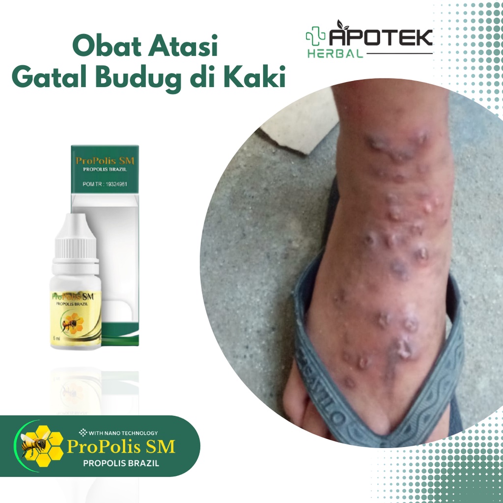 Obat Gatal Budug di Kaki, Gatal Kulit Bersisik, Obat Gatel Kaki, Obat Gatal Budug Bernanah, Obat Gat