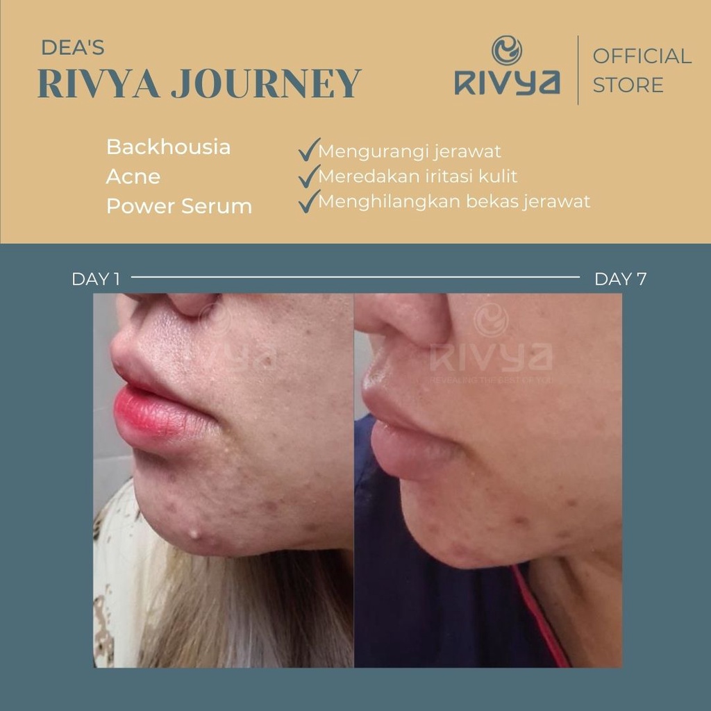 RIVYA Backhousia Acne Power Serum 20ml Serum Untuk Jerawat Aman Untuk  Busui dan Bumil