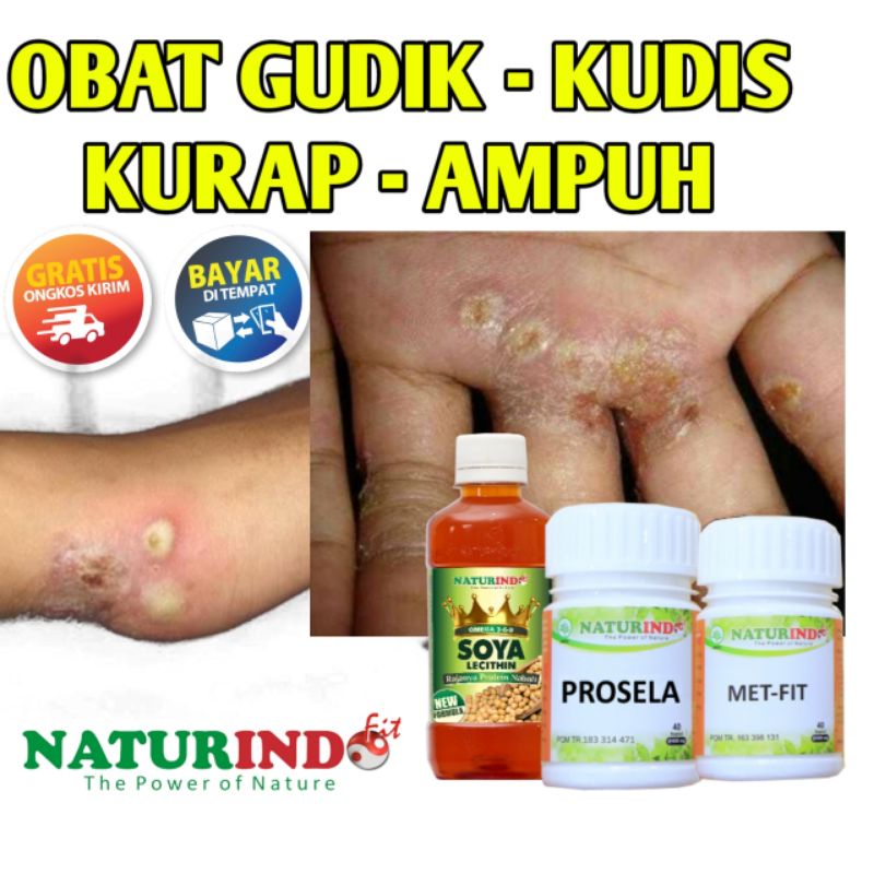 Obat gudik borok scabies kurap kutu air luka diabetes kulit gatal kronis paling ampuh