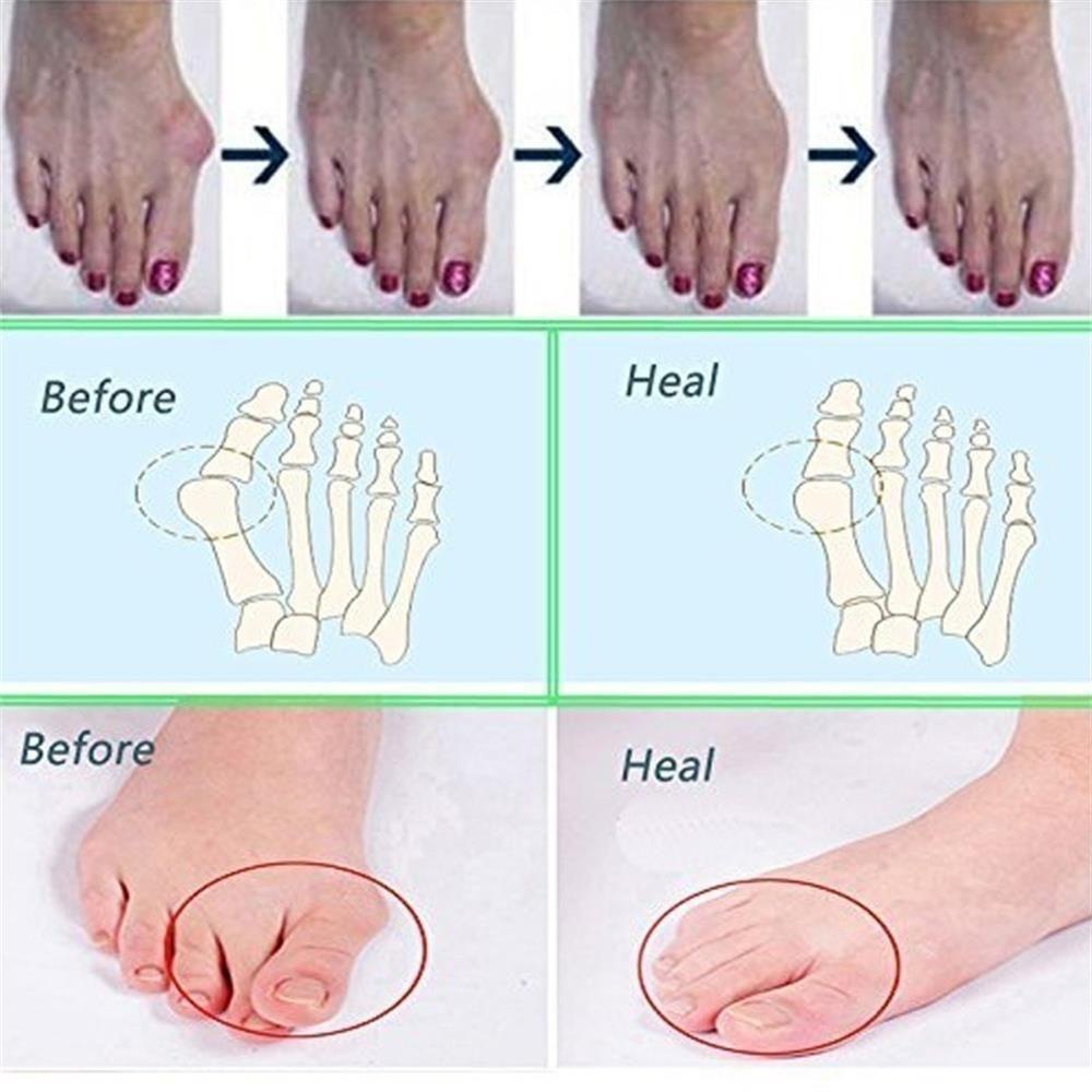 Suyo 1pasang Pemisah Jari Kaki Silikon Mudah Digunakan Perawatan Kesehatan Pereda Nyeri Align Toes Foot Care Tools