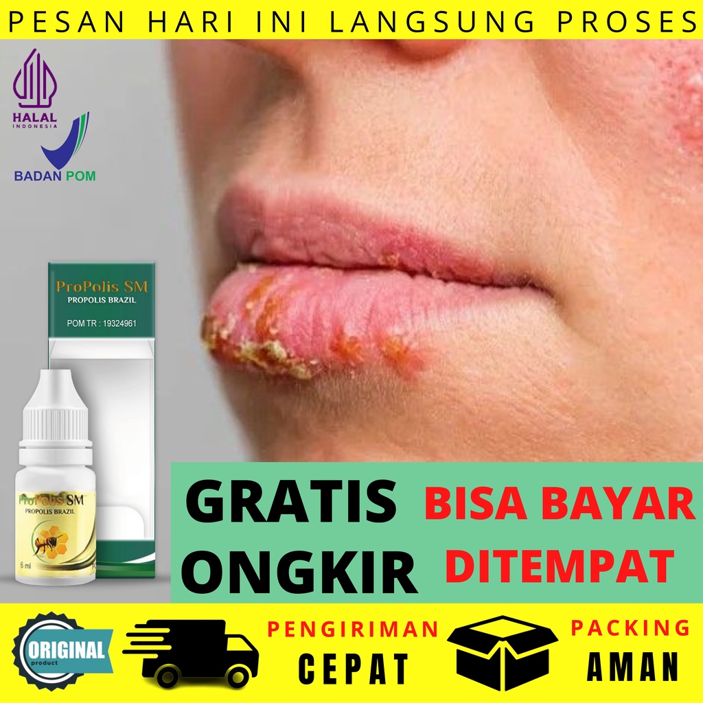Obat Herpes Dompo Kelamin Pria Luka Lepuh Bayi Anak Alami Benjolan Selangkangan Nyeri Otot Demam Tin