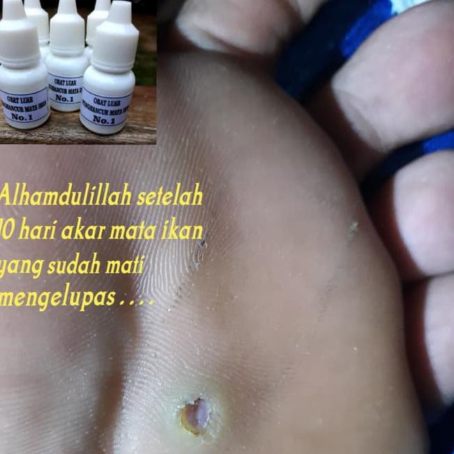 IQU5  penyakit mata ikan atau clavus bukan plester salep callusol .