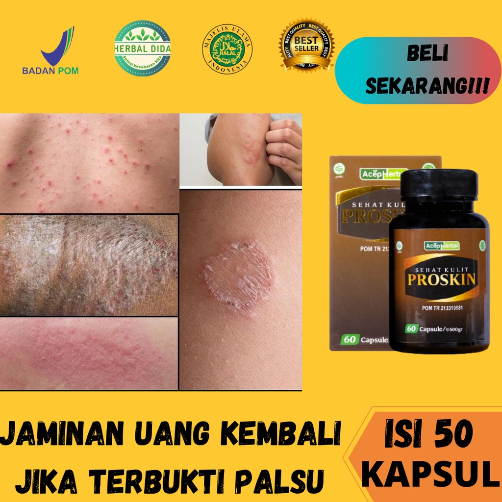 PROSKIN 100% ORIGINAL BPOM, Obat Gatal Kulit, Obat gatal kulit eksim, Obat Herbal Mengatasi Kulit Ga