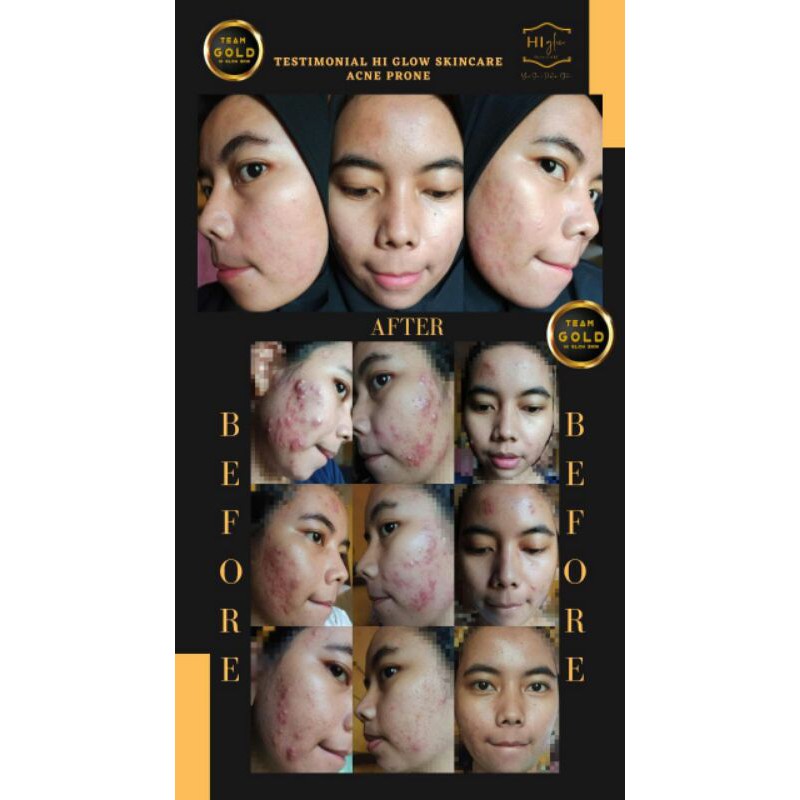 hi glow acne prone